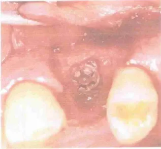 Figura 15  Retalho  mucopenosteal  Figura  16: Colocação  imediata de um implante 