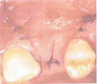 Figura 18: Retalho reposicionado em direção apical durante  a cirurgia de segundo estagio ,   com  o  pilar de cicatrização em 