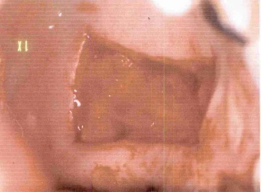 FIGURA  3-  Leito doador (palato) após a remoção do enxerto. 