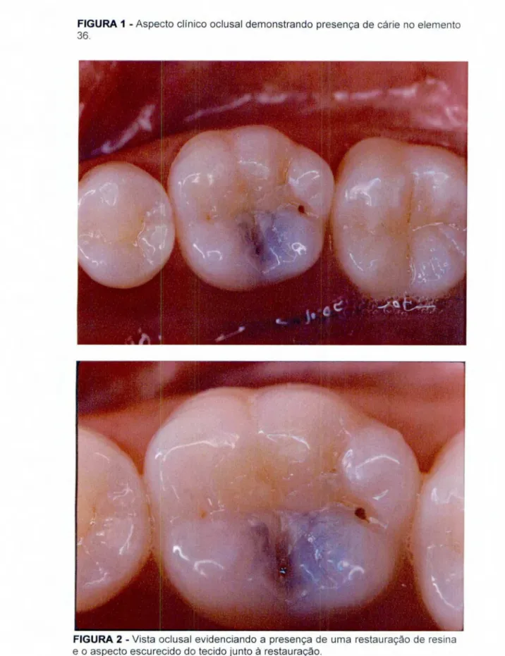 FIGURA 1 - Aspecto clinico oclusal demonstrando presença de cárie no elemento  36. 