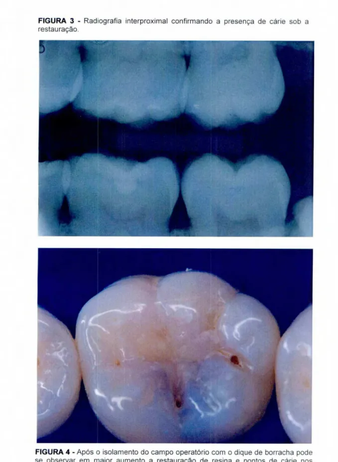 FIGURA  3 -  Radiografia  interproximal  confirmando a  presença  de cárie sob a  restauração