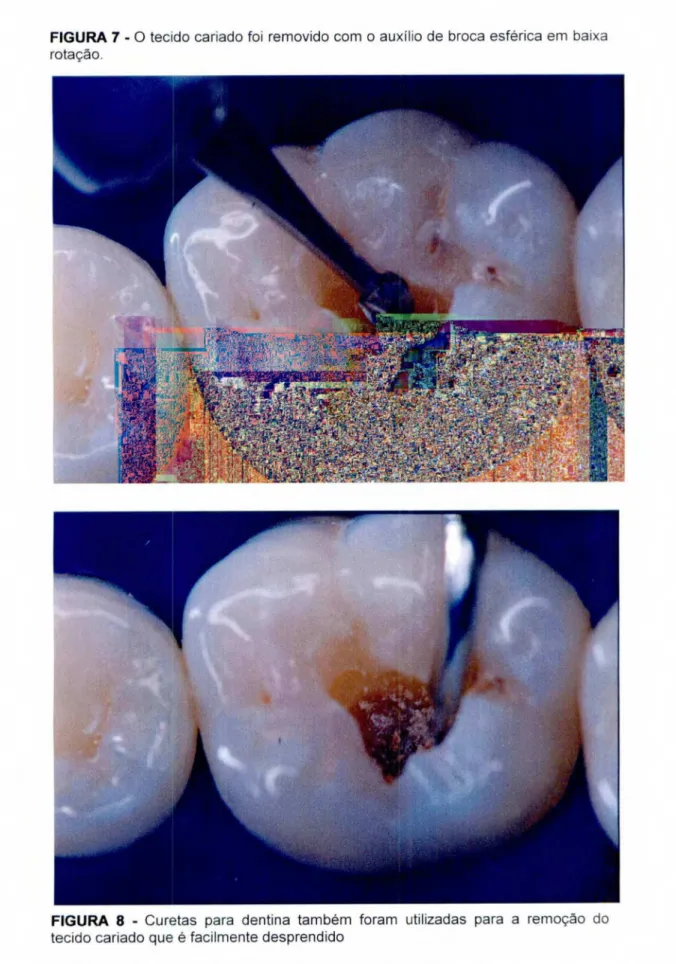 FIGURA  7 -  0 tecido cariado foi removido com  o  auxilio de broca esférica em baixa  rotação