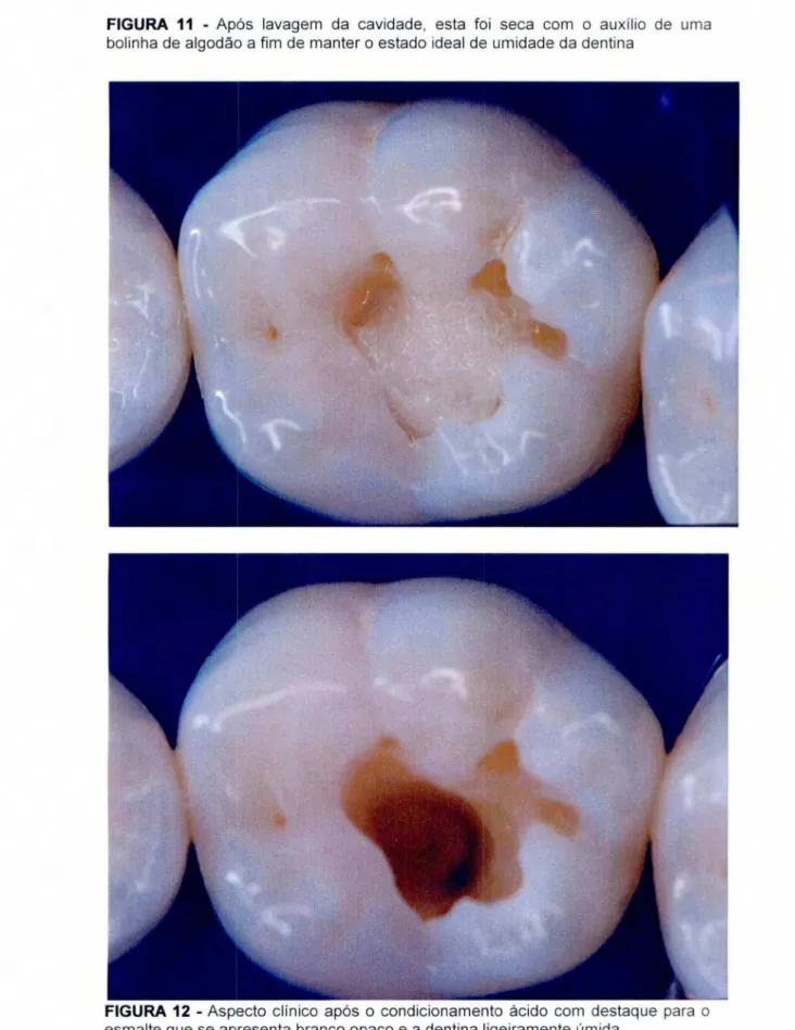 FIGURA 11 -   Após  lavagem da cavidade, esta foi seca com  o  auxilio de uma  bolinha de algodão a fim de manter o  estado ideal de umidade da dentina 