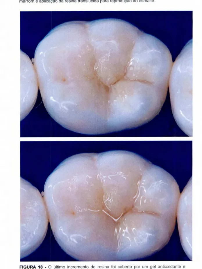 FIGURA  17 -  Aspecto da restauração  após  a caracterização dos sulcos com tinta  marrom  e aplicação da resina  translúcida  para reprodução do esmalte