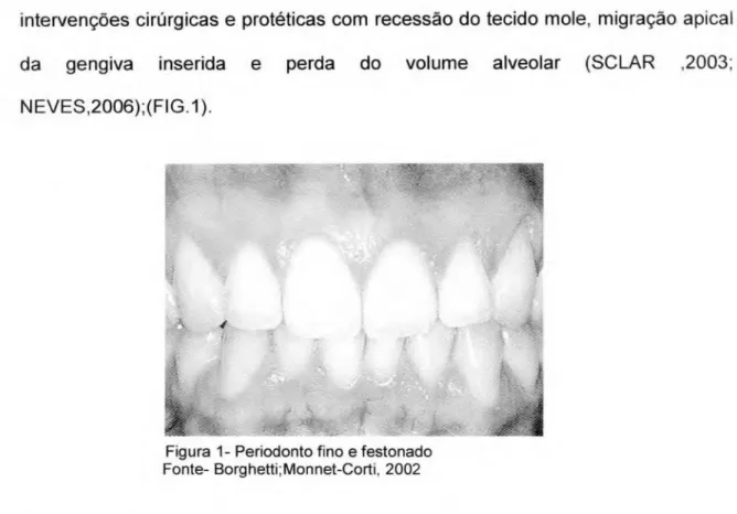 Figura 1- Periodonto fino  e  festonado  Fonte- Borghetti;Monnet-Corti, 2002 