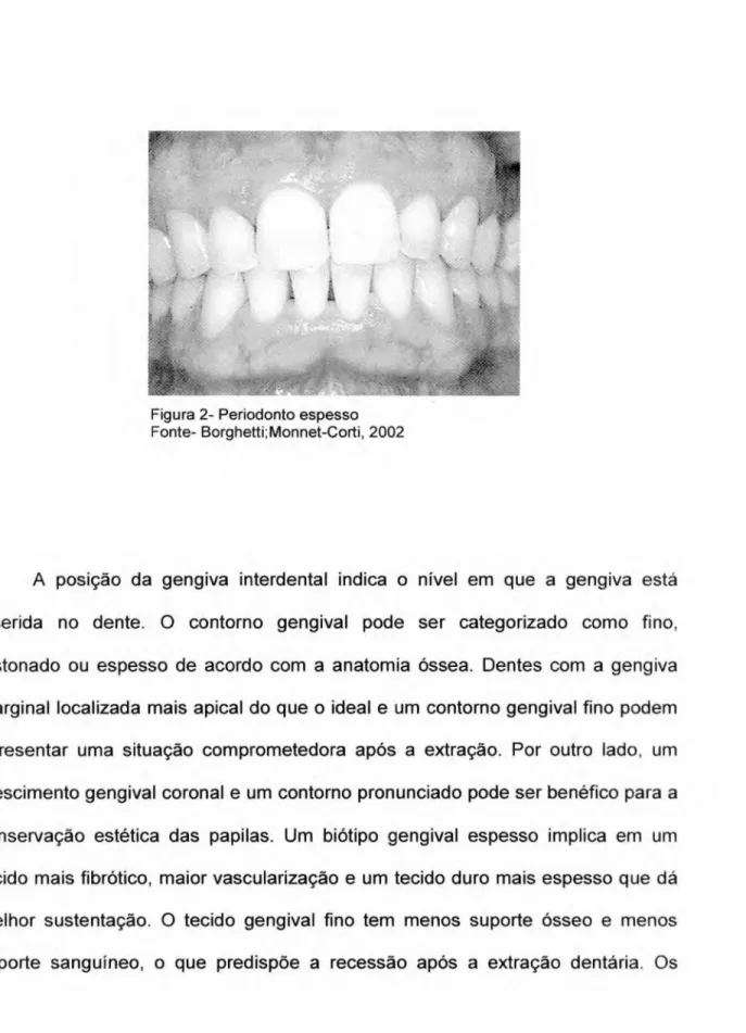 Figura 2- Periodonto espesso  Fonte- Borghetti;Monnet-Corti, 2002 