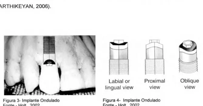 Figura 3- Implante Ondulado  Figura 4- Implante Ondulado 