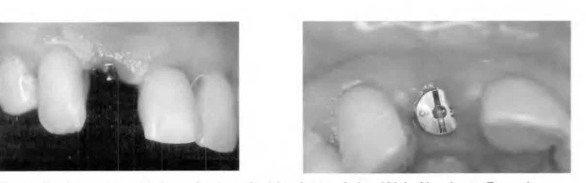 Figura  7  e  8 - momento  de reabertura de  1  implante  cônico (Alvin-Neodent - Parana  —  Brasil) regular que foi colocado na  região  do  12