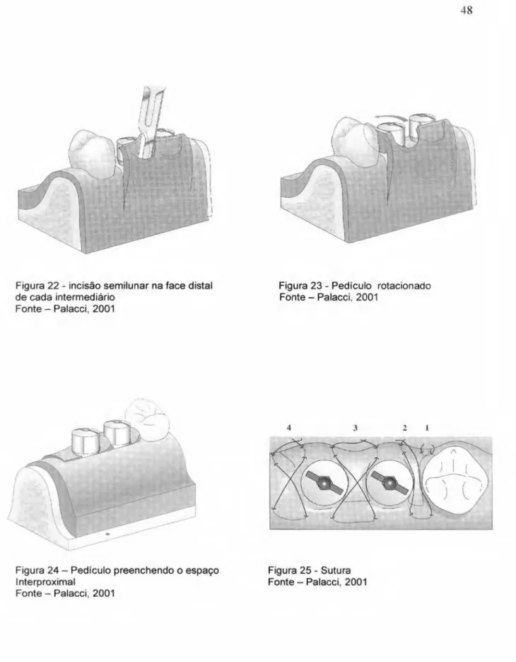 Figura 22 - incisão semilunar na face distal  Figura 23 - Pediculo rotacionado 