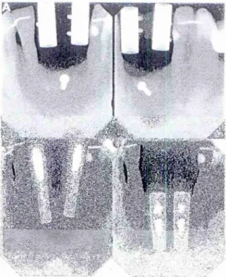 Figura 17.  Vista frontal das 2 impressões dos copings  colocados nos implantes  análogos  do modelo