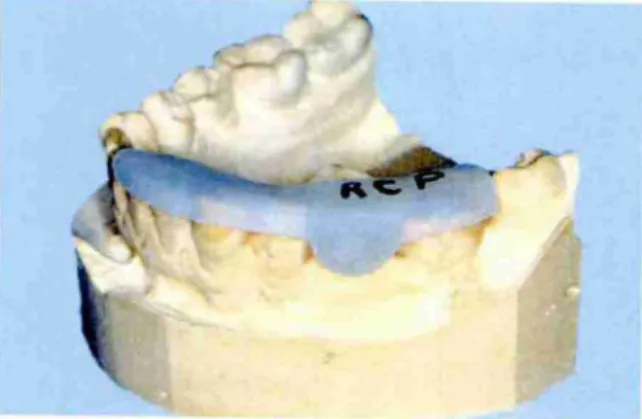 Figura 21. Local do implante com as linhas de refe- refe-rdncia traçadas para determinar a localização  vesti-bulolingual  e  mesiodistal  do implante