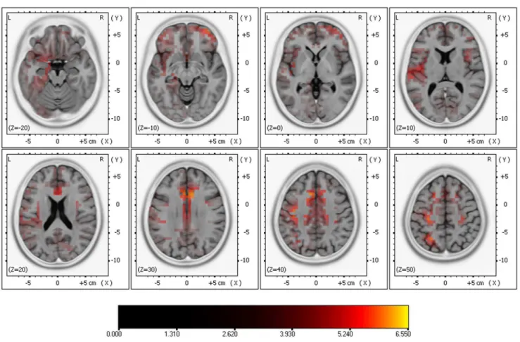 Figure 2. Results of comparing high vs. low SPLs in the source localization anaylsis using sLORETA