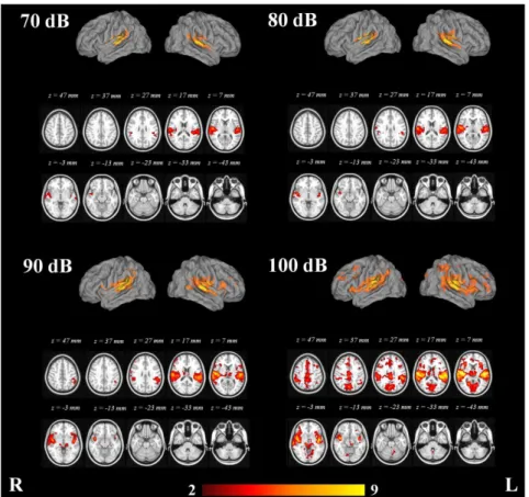 Table 2. Clusters exhibiting activation with the 70, 80, 90 and 100 dB tones in the fMRI data analysis