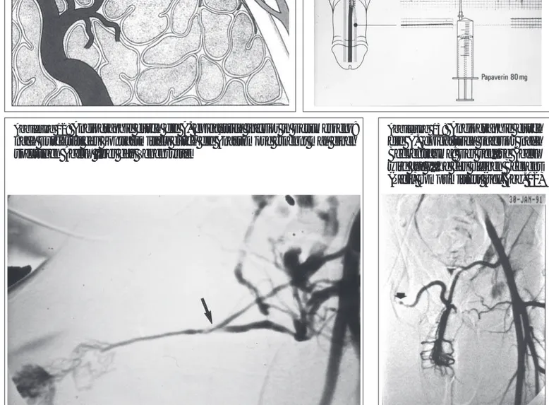 Abbildung 13:  Angiographie durch die A. epigastrica inferior nach Beckentrauma: Der venöse Abfluß wird auf Höhe des kleinen Beckens (Pfeil) komprimittiert (vgl