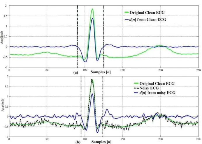 Fig. 6 presents the original clean and noisy ECG signals, and the respective plots of d[n] in each case