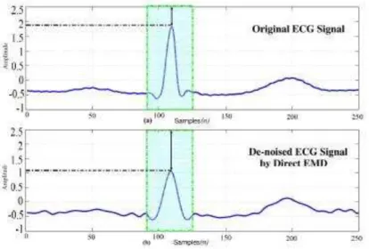 Figure 3: (a) Original ECG signal; (b) Denoised ECG signal using conventional EMD method