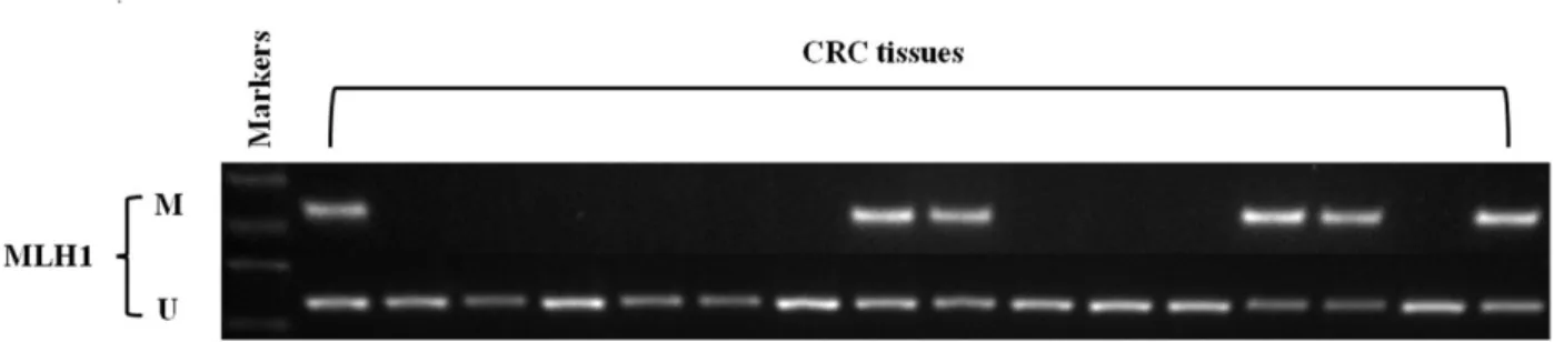 Fig 1. Representive MSP (Methylation-specific PCR) results of MLH1 methylation in colorectal cancer with loss of MLH1/PMS2 protein expression.