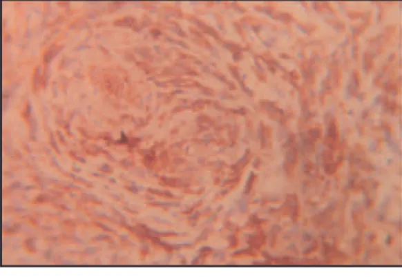 Fig. 7 : Spindle cells positive for vimentin