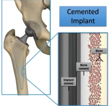 Table 1.4  –  Components of bone cement. 