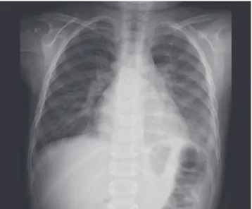 Fig. 3. Echocardiography showed large muscular-type VSD near the  apex, and an enlarged left ventricle