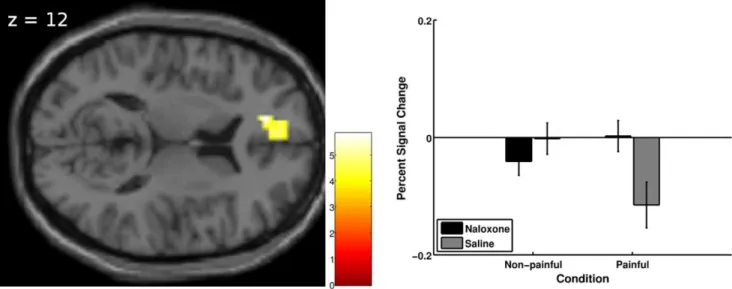 Figure 4. Treatment by intensity interaction. Left: Results (visualization threshold p,0.001 uncorrected) related to the treatment (naloxone vs.
