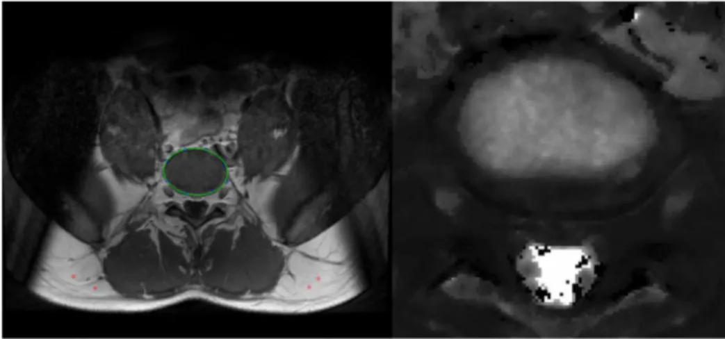 Figure 4. DT1-maps. Subject A, L1/2 divided into sectors, before (left) and after (right) bedrest.