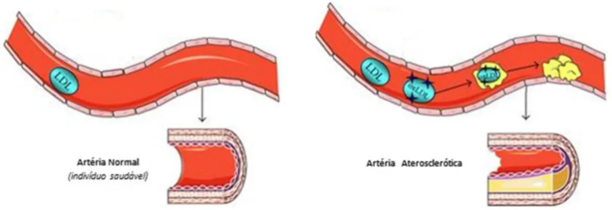 Figura 1.1:Representação esquemática do desenvolvimento de aterosclerose em comparação com uma artéria de um  indivíduo saudável, adaptado de Witte 2012