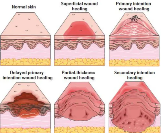 Figure 1.2 Schematics of the five basic models of healing and corresponding wound depth
