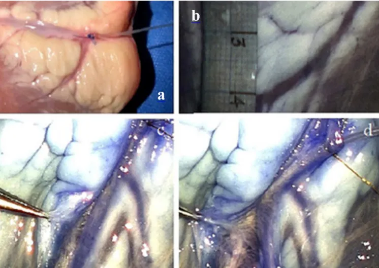 Figure 2. a) catheter positioned for dye injection; b) distal vessels are less gibbous and have more tributaries; c,d) magnified  dissection with the aid of blue dye for better identification of planes and perforators.