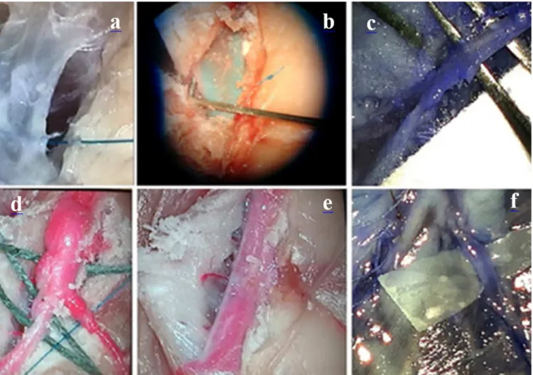 Figure 4. Use of dye in the microscopic coronary dissection process. In this model, red and blue inks were used, what helped  in the identification of planes for dissection and of perforators: a) dissected vessel without dye; b) blue dye in deep vessel; 