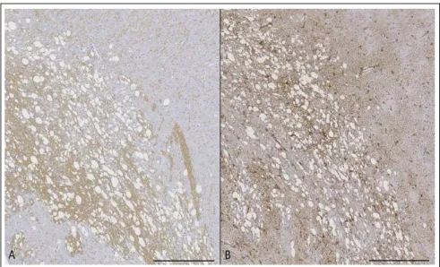 Figure 2 - Immunohistochemical study of the parietal cortex (same spongiotic area shown in Figure  1-D)