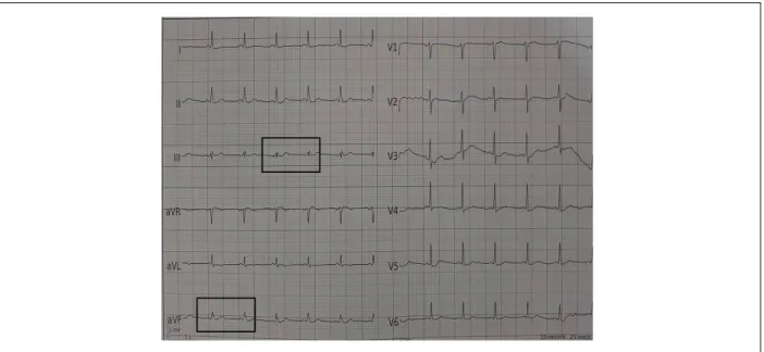 Figure 2 – An example of fragmented QRS in our study population.