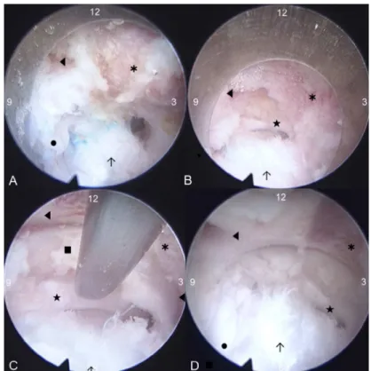 Figure 3  - Endoscopic views of the procedure. 12 o’clock is midline ( right side), 3 is caudal, 6 is lateral (left side)  and 9 is cranial