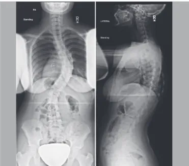 Figure 1. Coronal and sagittal radiographs of a 14 year-old female  with 58° preoperatively