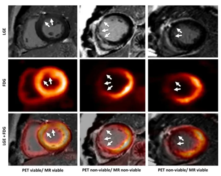 Figure 1 – “Images illustrating different combinations of FDG uptake and LGE transmurality
