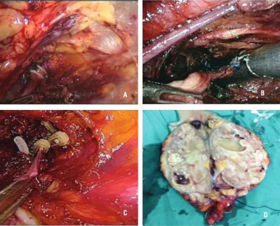 Figure 2 - The different methods of mutilation of the distal ureter.