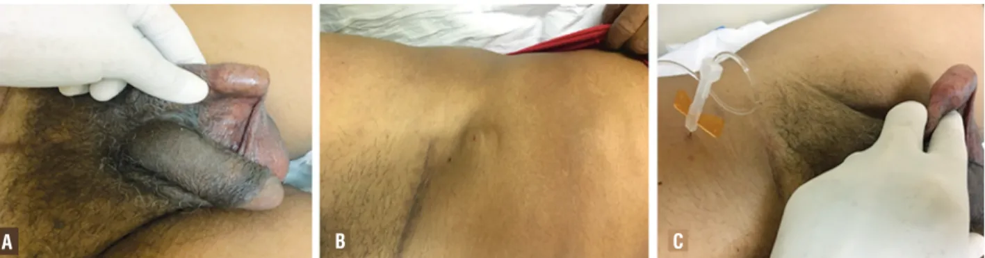 Figure 3 - Surgical technique and device implantation steps: 1-2) Perineal and inguinal incision, respectively; 3) Inguinal  tunnel construction and device passage; 4) Device in the perineal region; 5-8) Periurethral cuff being activated and locked.