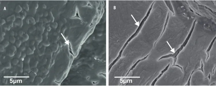 Figure 6 - FE-SEM micrographs of struvite crystals grown in artificial urine infected with Pseudomonas aeruginosa  revealing the porous structure and mesoscopic arrangement (a) control (b) in presence of vitamin C (1 mg/mL)