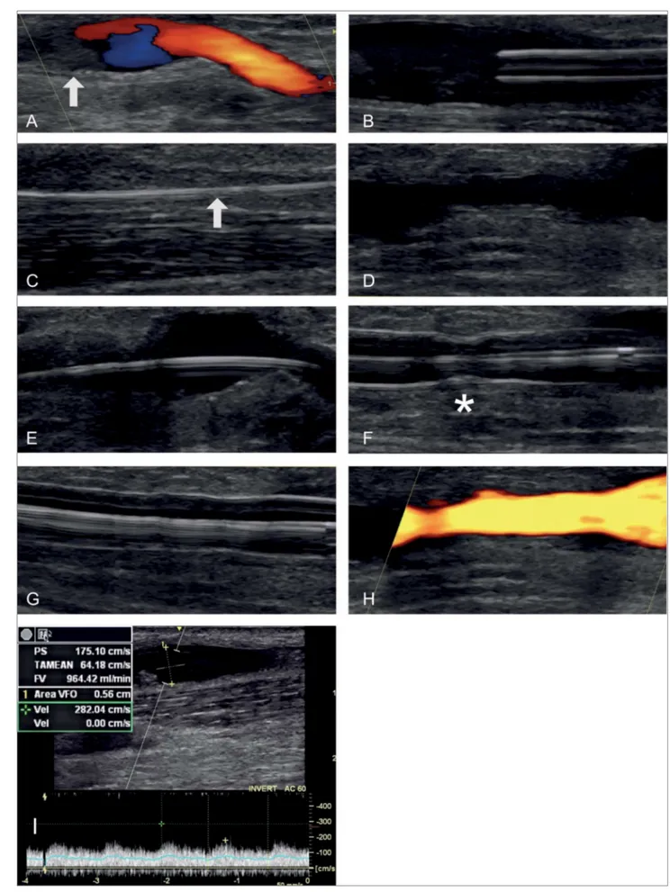 Figure 2. AVF thrombolysis and angioplasty guided by ultrasound (US). A, Juxta-anastomotic region US showing flow on color Doppler and  echogenic thrombus (arrow) in the AVF