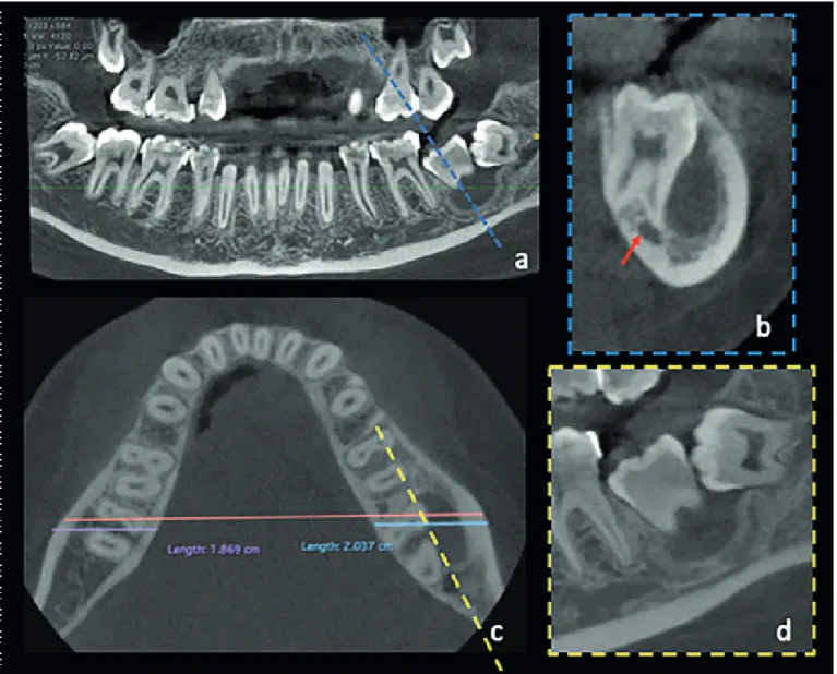 Figure 2.  CBCT exam. (a) Panoramic reconstruction (0.18mm thickness) showing a cystic lesion which the upper limit is located in the cervical region of the  impacted left second molar