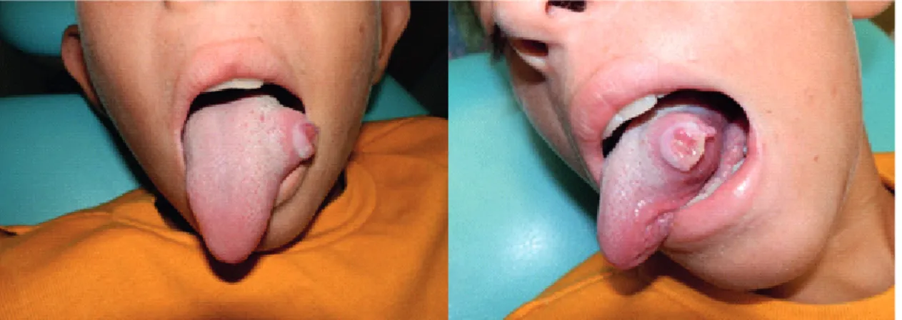Figure 1. Clinical image of tumoral lesion in left lateral border of tongue.