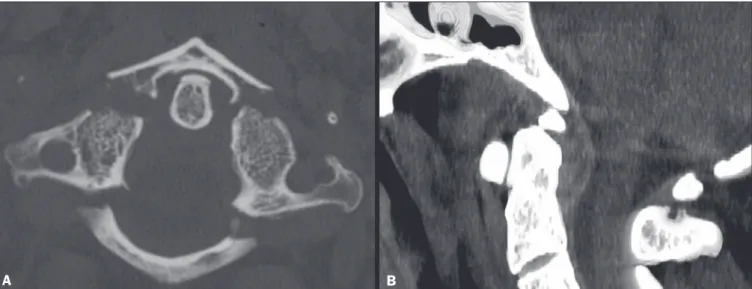 Figure 2.  Head CT including the first two vertebrae in a 74-year-old patient with frontal trauma, a GCS score of 15, and no cervical symptoms
