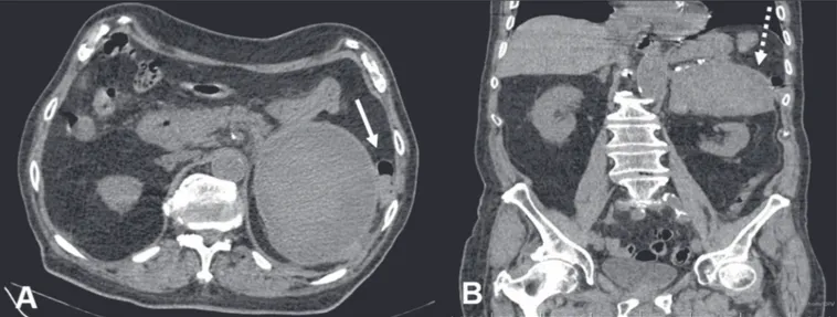 Figura 2. TC de abdome demonstra massa na adrenal esquerda, de contornos regulares e bem definidos, medindo 12,5 × 10,1 × 7,7 cm e atenuação pré-  contraste de 45 UH