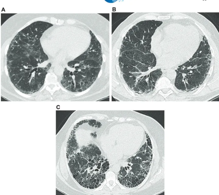 Figure 1 - Common features on high-resolution computed tomography in interstitial lung diseases