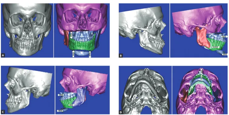 Figure 7 - Virtual surgical planning of bone movements in frontal (A), right (B), left (C) and lower (D) views.
