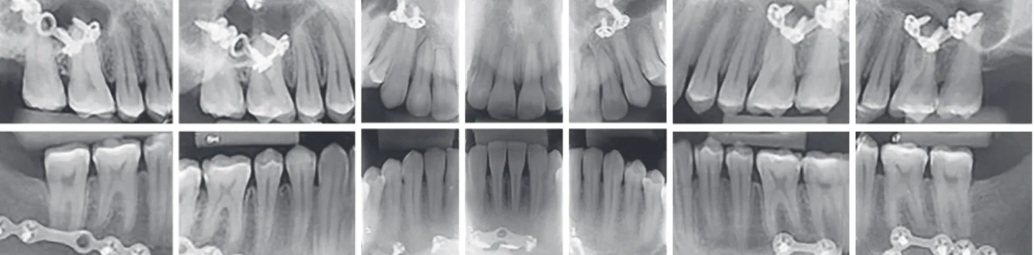 Figure 9 - Final periapical radiographs.