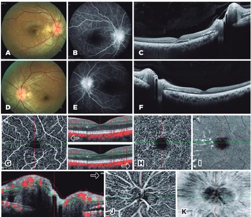 Figure 1. On the first day. A) Fundus image of the right eye; optic disc edema and star-like exu- exu-dation