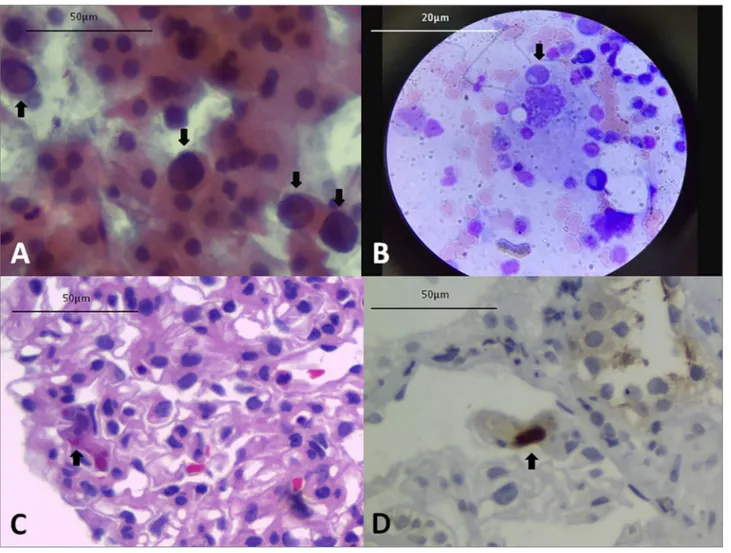 Figura 1. A) células urinárias decoy (Papanicolaou). B) Hemofagocitose no aspirado de medula óssea (Giemsa)