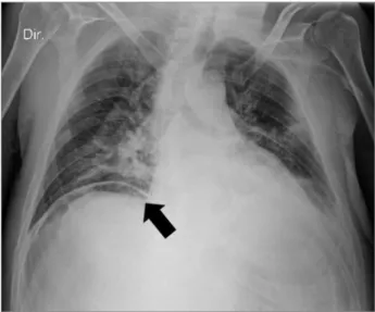 Figura 1. Radiografia torácica do paciente exibindo pneumoperitônio  (seta preta).