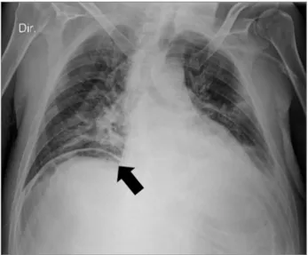 Figure 1. Patient’s thoracic radiography showing a pneumoperitoneum  (black arrow).